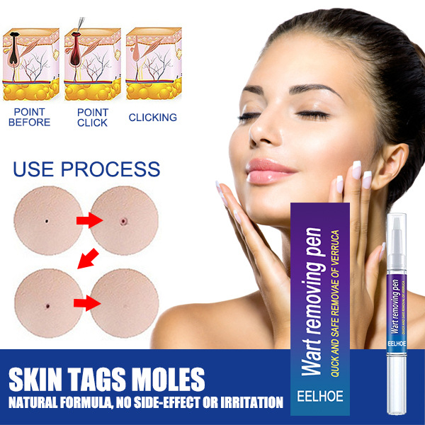 Warts Remover Cream Wart Treatment Cream Skin Tag Remover Foot Corn Antibacterial Warts Cream Latest upgrade version