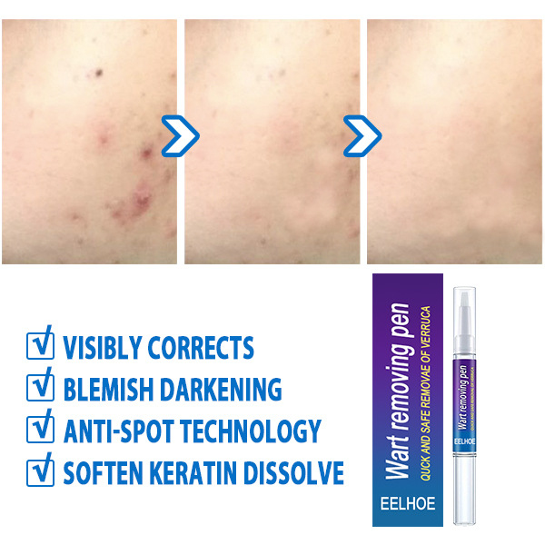Warts Remover Cream Wart Treatment Cream Skin Tag Remover Foot Corn Antibacterial Warts Cream Latest upgrade version