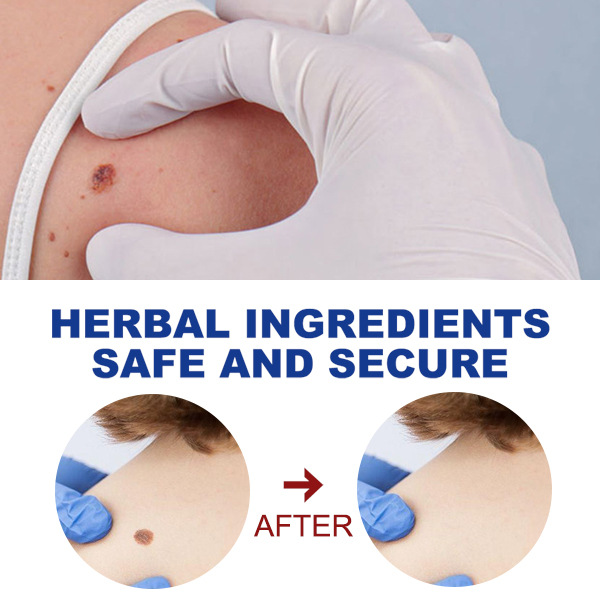 Warts Remover Cream Wart Treatment Cream Skin Tag Remover Foot Corn Antibacterial Warts Cream Latest upgrade version
