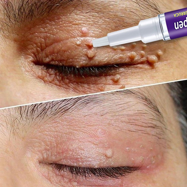 Warts Remover Cream Wart Treatment Cream Skin Tag Remover Foot Corn Antibacterial Warts Cream Latest upgrade version