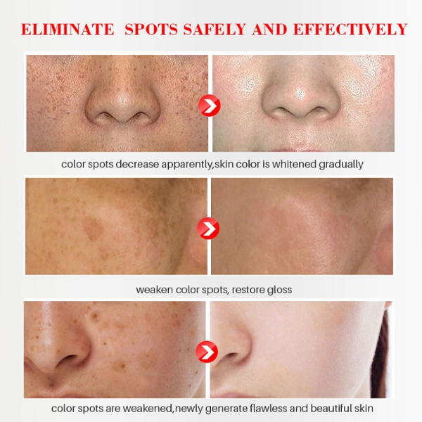 Whitening Freckles Cream Remove Melasma Dark Spots Lighten Melanin Melasma Remover Moisturizing Makeup