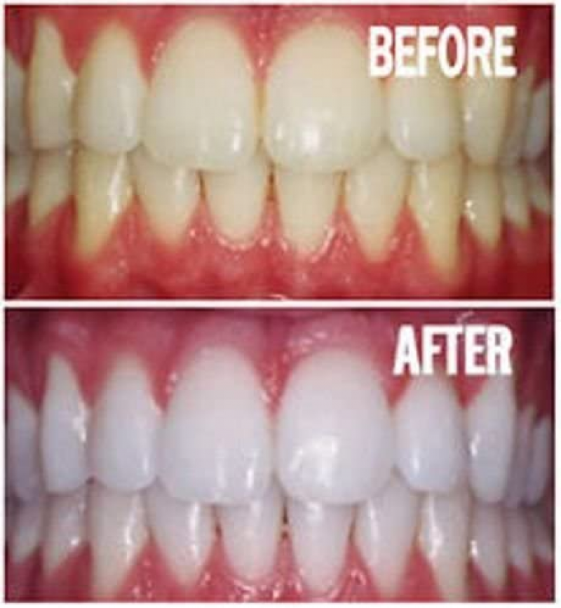 10Pcs/Lot Teeth Whitening GEL Syringe Peroxide Dental Bleach Gel  Bleaching Teeth Whitening Gel 3ml