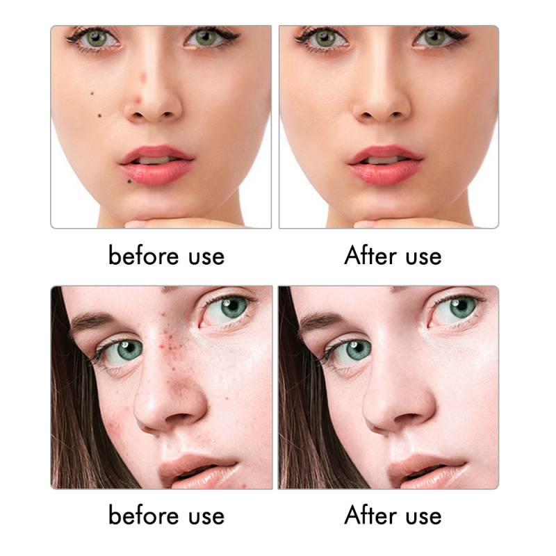 New Arrival 9 Levels LCD Laser Plasma Pen Mole Tattoo Freckle Wart Tag Removal Pen Dark Spot Remover For Face Skin Care Tools Beauty Machine