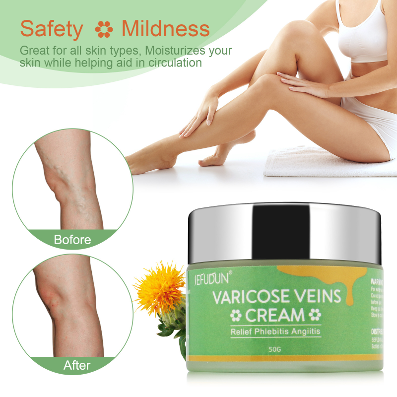 Varicose Vein Repair Cream Tongmai Effective Relieves Vein Remove Treatment Vasculitis Cream Leg Pain 50g Bulge Phlebitis