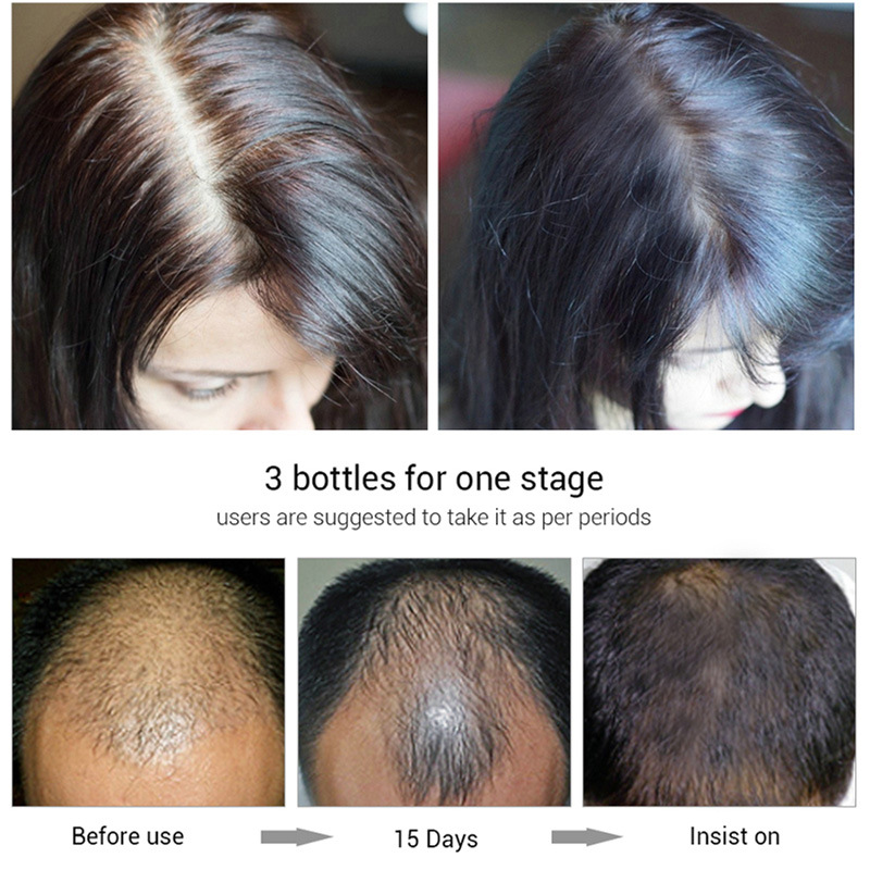 Hair Growth Essential Oil Promoting Hair Growth Prevent Baldness Scalp Anti Hair Loss for Men Women