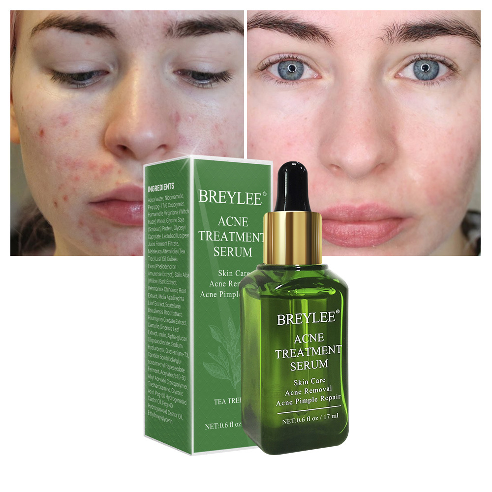 BREYLEE Bean Removal Essence Original Liquid qu beans qu acne whiteheads blackheads closed pores skin BY4357