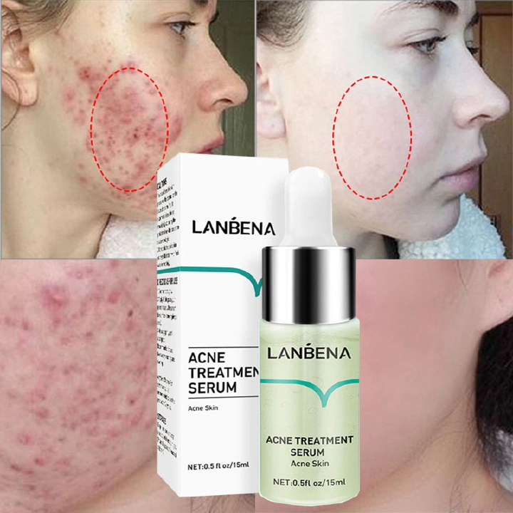 LANBENA Acne Removal Serum Salicylic Acid Anti-Acne Repair Fade Acne Spots Pimple Oil Control Cream Whitening Moisturizing Care