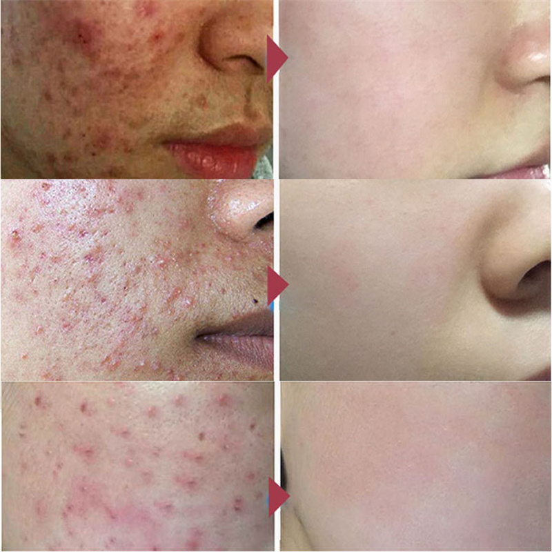 LANBENA Acne Removal Serum Salicylic Acid Anti-Acne Repair Fade Acne Spots Pimple Oil Control Cream Whitening Moisturizing Care
