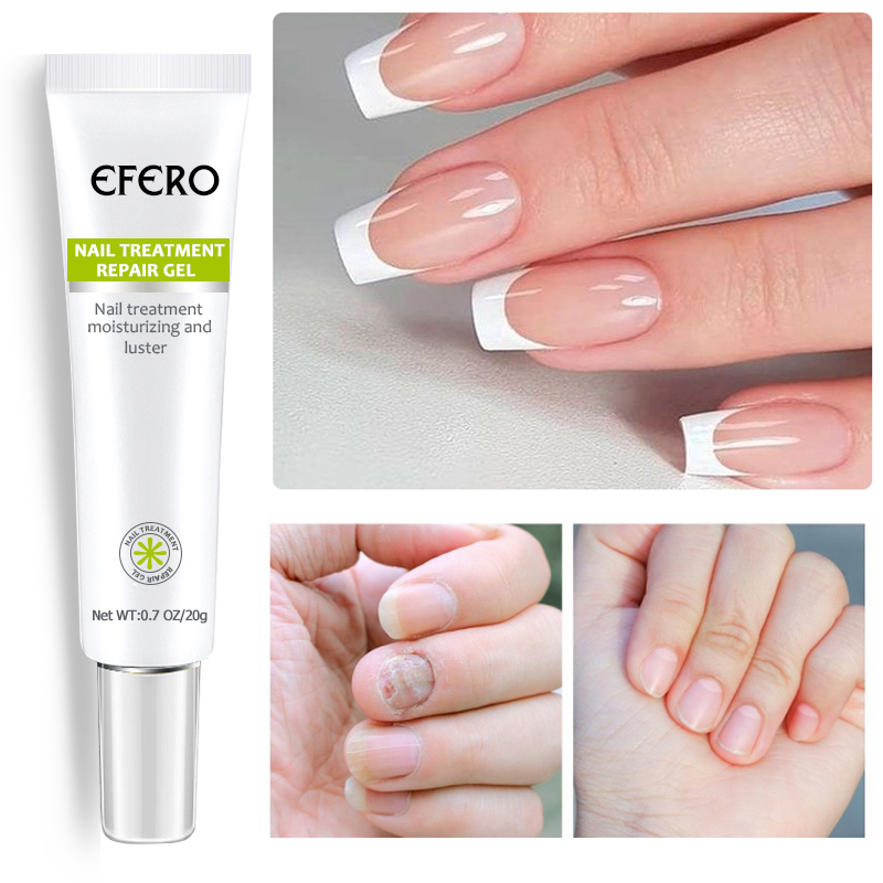 Fungal Nail Serum Repair Essence Foot Nail Fungus Removal Gel Anti Infection Paronychia Onychomycosis Nail Treatment