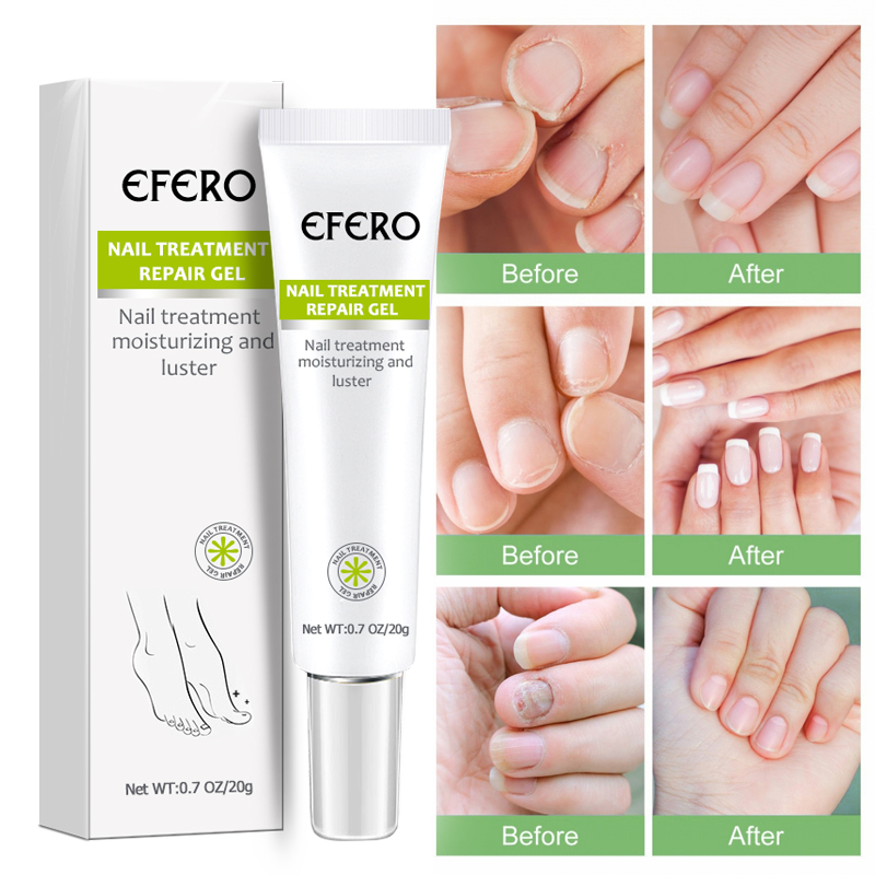Fungal Nail Serum Repair Essence Foot Nail Fungus Removal Gel Anti Infection Paronychia Onychomycosis Nail Treatment