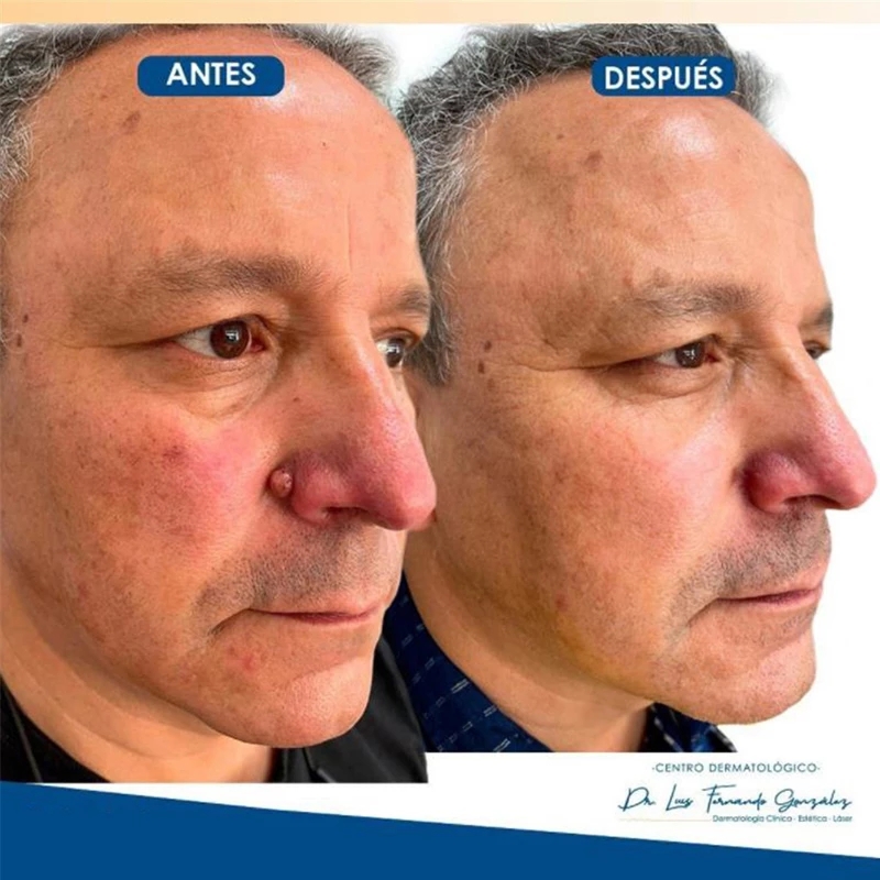 Remover Cream Clean Painless Mole Skin Dark Spot Warts Remover Face Wart Tag Treatment Men Women Serum Freckle Removal