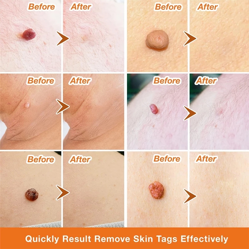Remover Cream Clean Painless Mole Skin Dark Spot Warts Remover Face Wart Tag Treatment Men Women Serum Freckle Removal