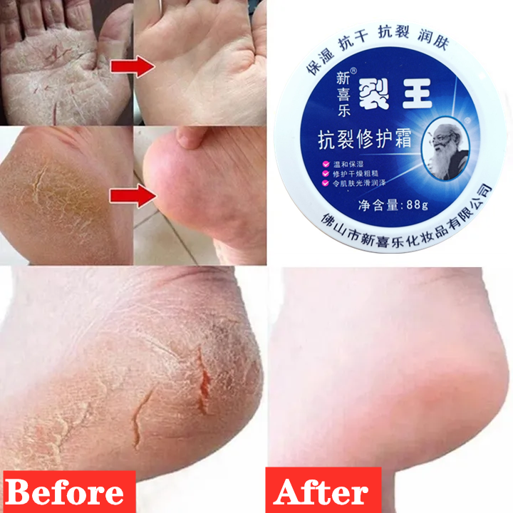 Anti-Crack Repair Cream 88g Moisturizing Anti-Dry Hand, Foot and Heel Crack King Cream Face Cream