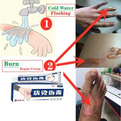 Burn and scald ointment boiling water scald ointment blistering scald repair topical skin cream As Picture 20g